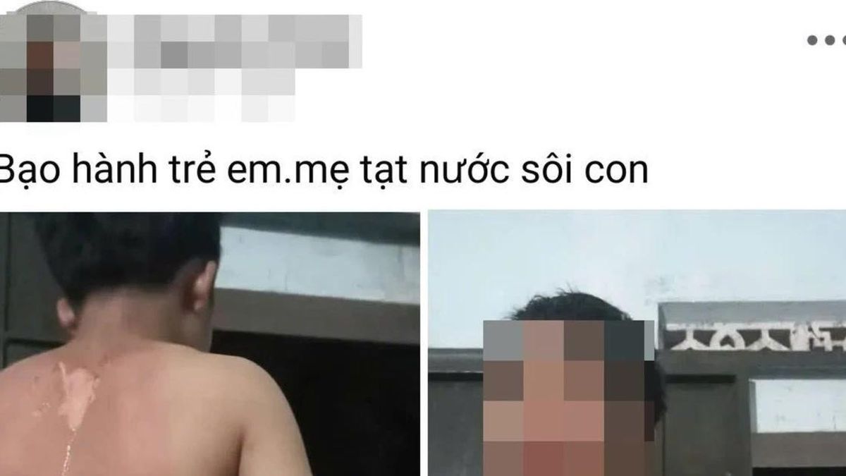 Công an vào cuộc vụ bé trai ở Đắk Lắk nghi bị mẹ tạt nước sôi - Báo Tiền Phong